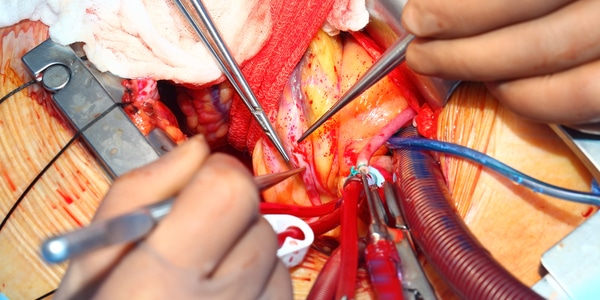 Principes van cardioplegie voor anesthesiemedewerkers