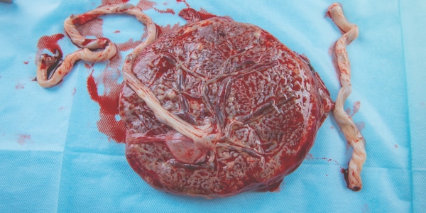 Manuele placenta verwijdering