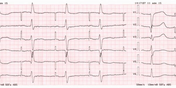 Principes van externe pacemaker voor recoveryverpleegkundigen